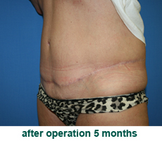 plastic-surgery-tummy-tuck